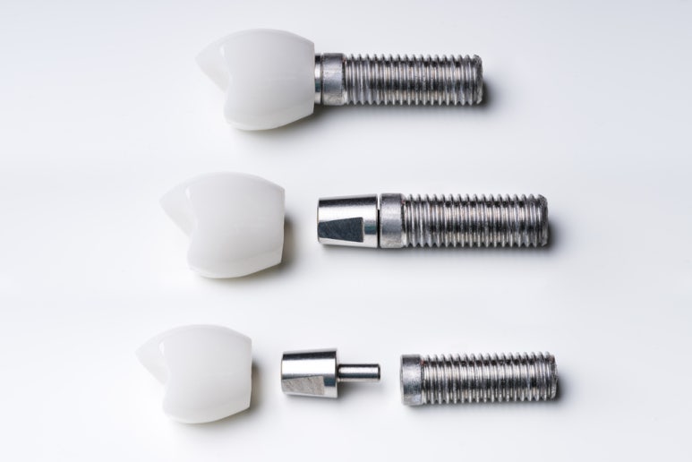 Various Questions and Answers About Implants image 3