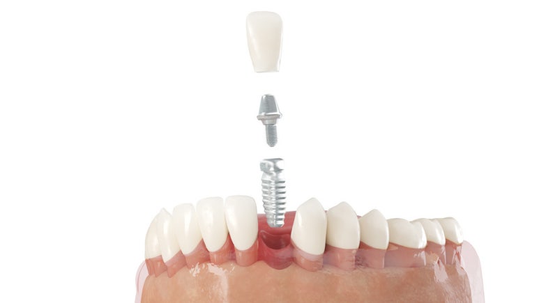 Your Precious Teeth, Implants at Seokplant! image 2