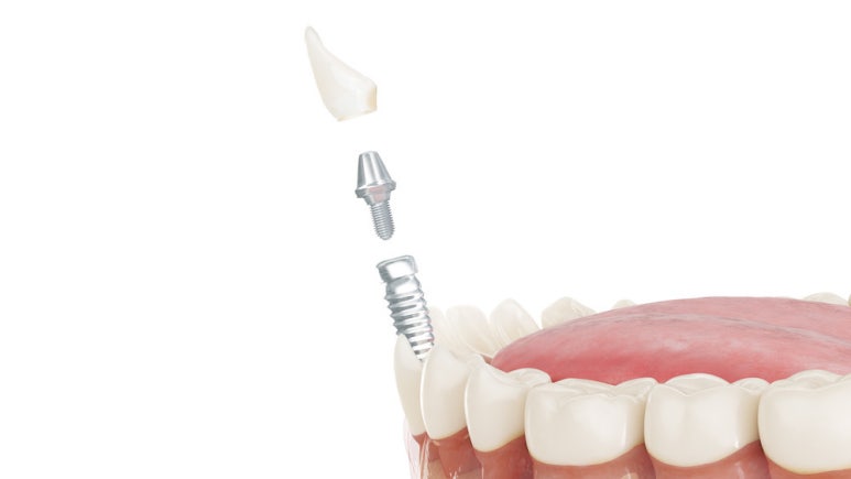 If Your Teeth Ache Every Time You Drink Water? image 4