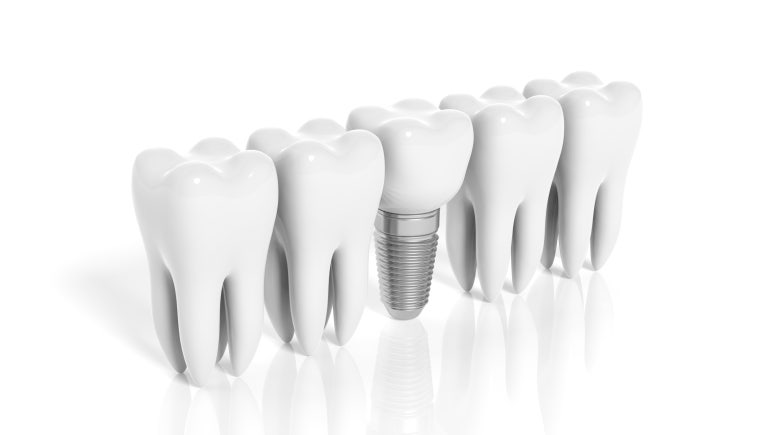 What Are the Types of Implants? Seokplant Dental Hospital image 2