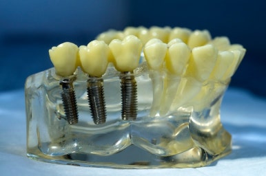 Regaining Youth with Full-Mouth Implants image 5