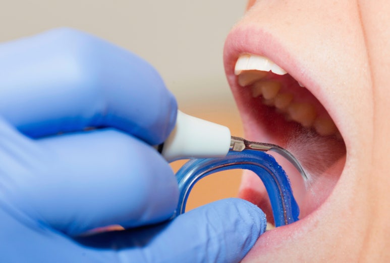 If You Want Implants to Last a Long Time, You Need to Change Your Habits image 2