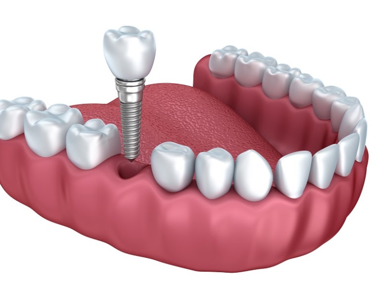 If You’re Looking for a Place That Does Affordable, Quality Implants, Learn About Seokplant Dental Hospital image 2