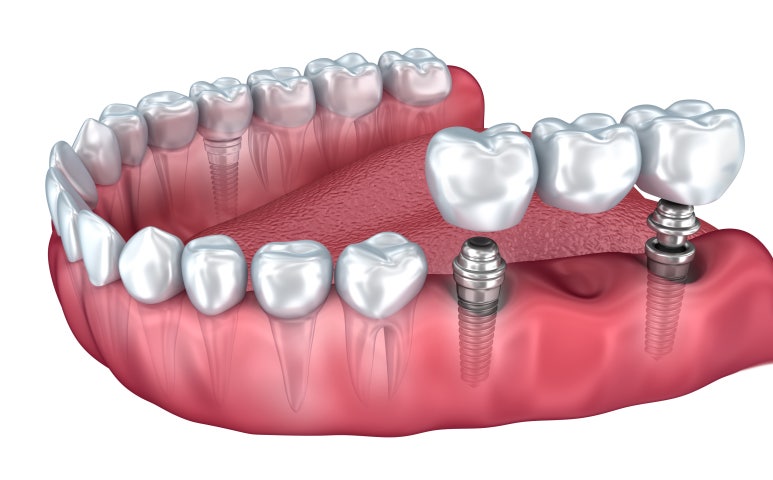 What Is Full-Mouth Implant Treatment? image 1