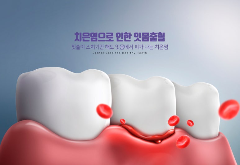 How to Deal with Periodontal Disease Wisely image 4