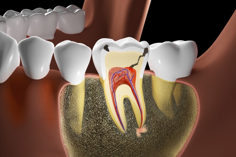 Why Is a Molar Implant Needed? Seokplant Dental Hospital image 3
