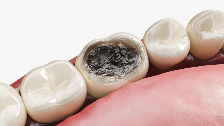 The Longer You Put Off Dental Care, the Worse the Damage to Your Teeth Becomes image 1