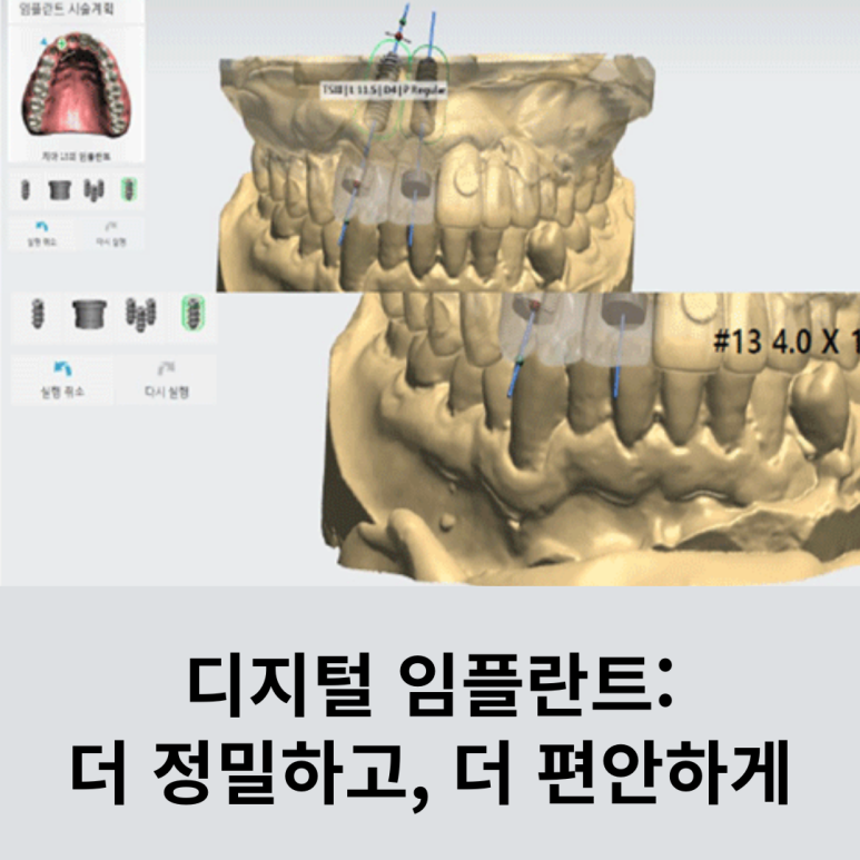 Digital Implants: More Precise, More Comfortable image 8