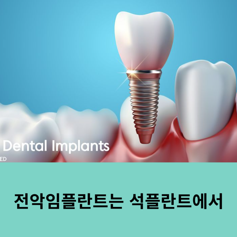 전악임플란트는 석플란트에서 관련 이미지 9