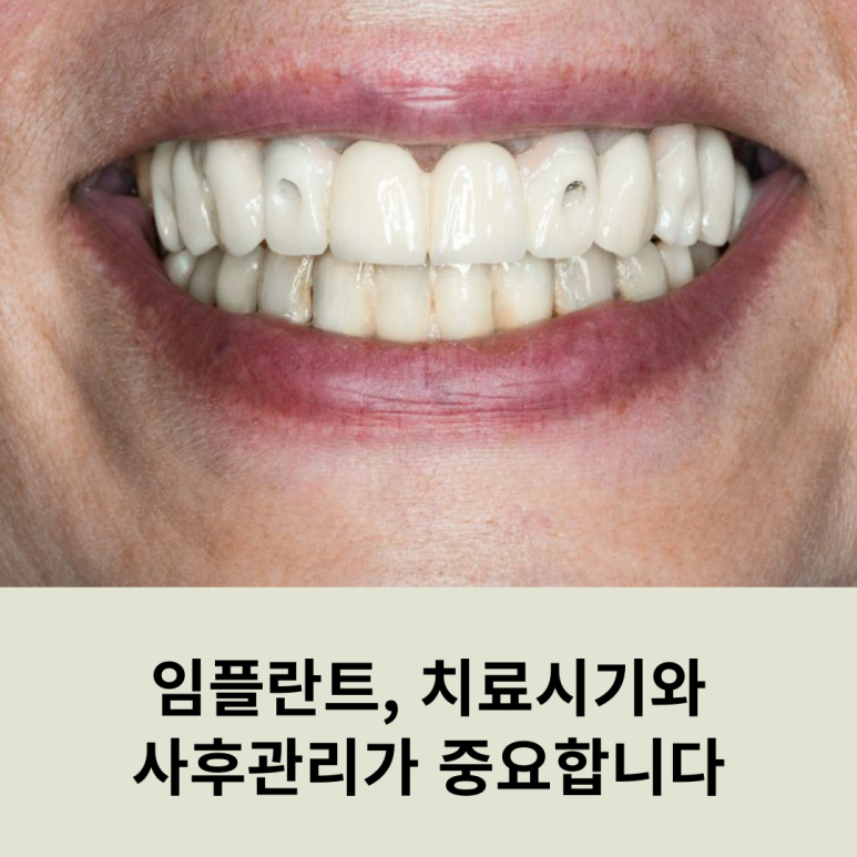 Implants: Treatment Timing and Aftercare Are Important! image 9