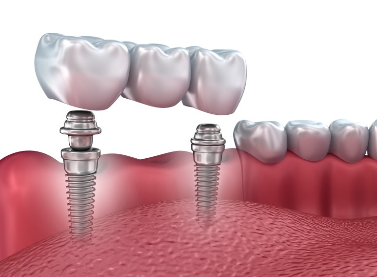 What Is Full-Mouth Implant Treatment? image 2
