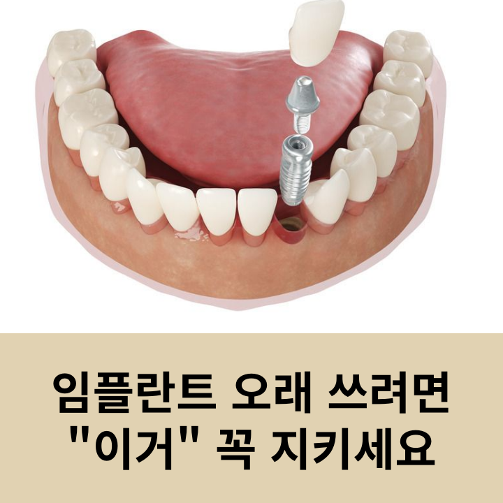 Make Sure to Follow These Tips to Make Your Implants Last Longer image 5