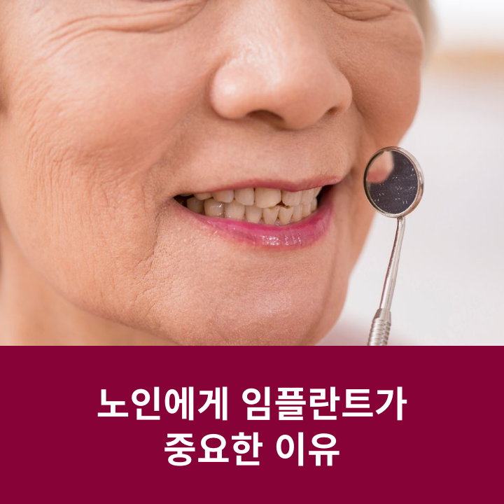 노인에게 임플란트가 중요한 이유 관련 이미지 4