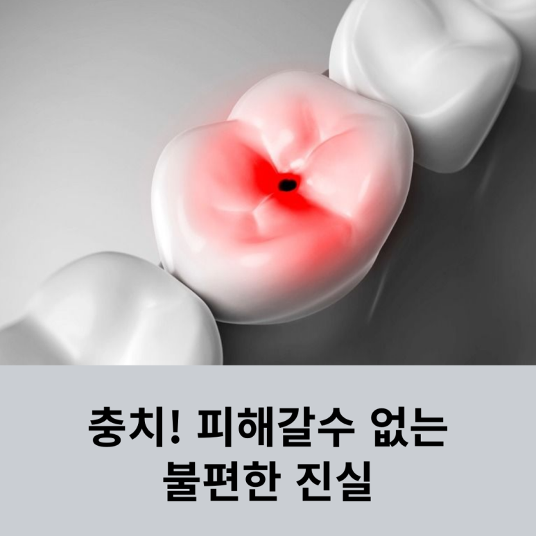 충치! 피해갈수 없는 불편한 진실 관련 이미지 8