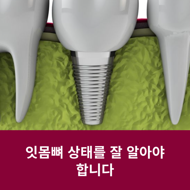 잇몸뼈 상태를 잘 알아야 합니다 관련 이미지 9