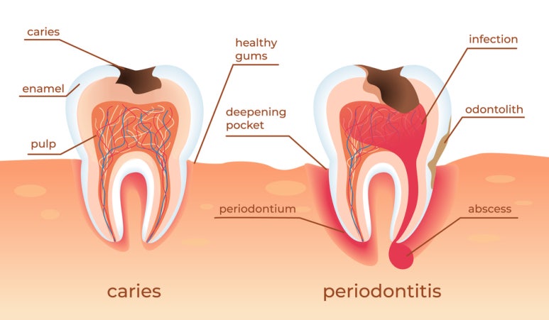 How to Deal with Periodontal Disease Wisely image 1
