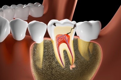 Comparing Meals and Foods After Implant Surgery image 11