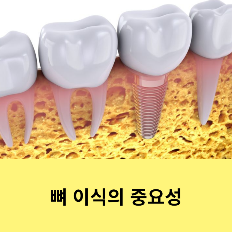 뼈 이식의 중요성 관련 이미지 9