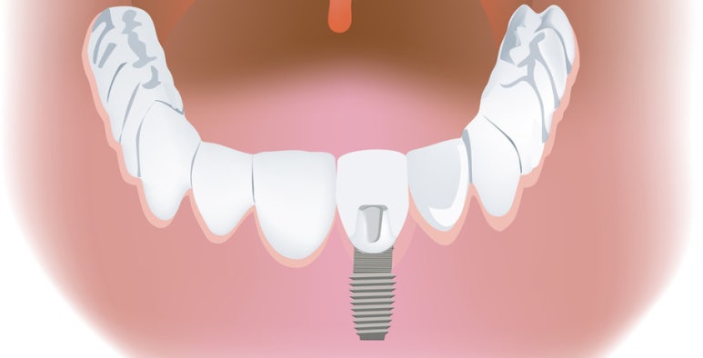 Implant Lifespan: Using It Longer with Proper Care image 1