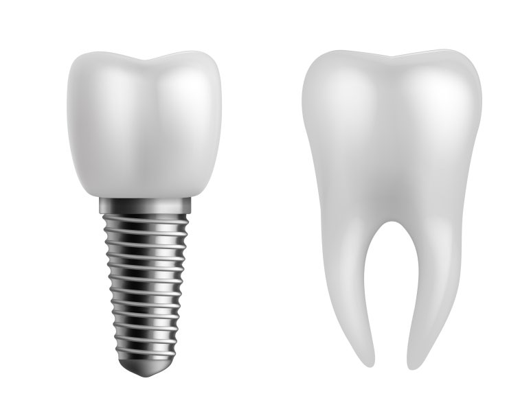 The Full Implant Placement Process: Does It Hurt? How Long Does It Take? - Seokplant Dental Hospital image 1