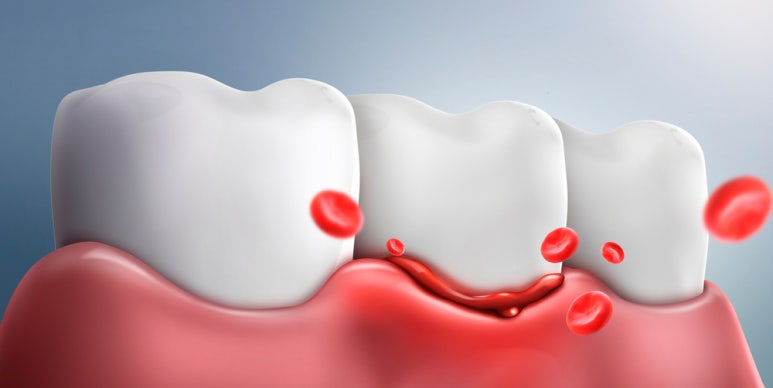 Side Effects and Precautions of Implants image 1