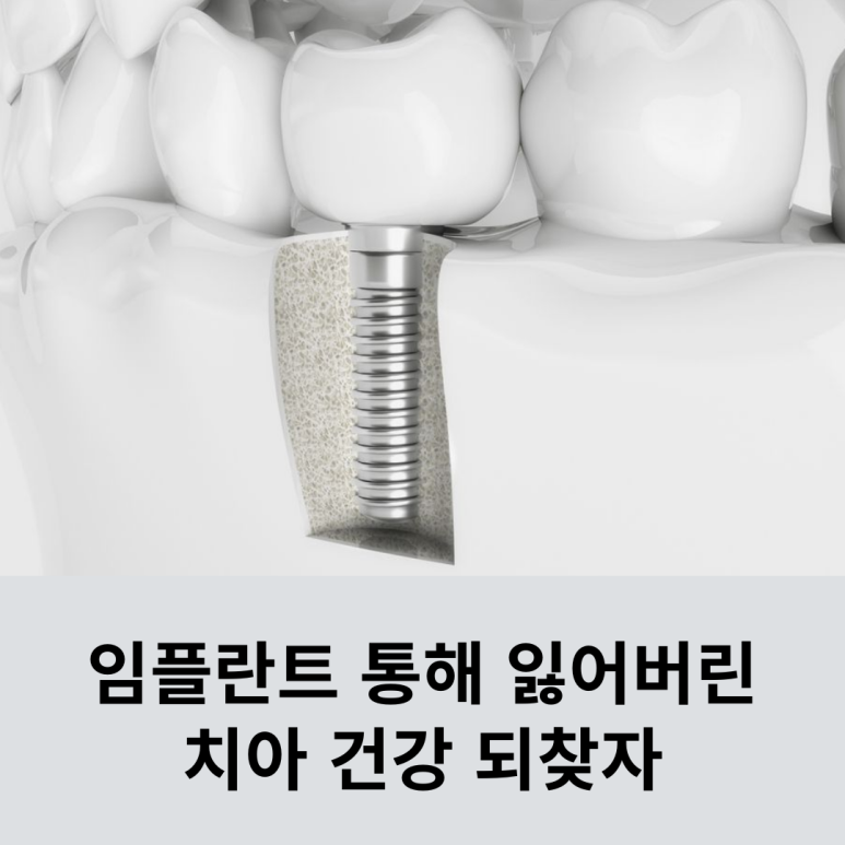 임플란트 통해 잃어버린 치아 건강 되찾자 관련 이미지 10