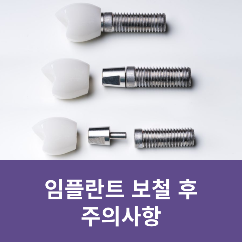 임플란트 보철 후 주의사항 관련 이미지 8