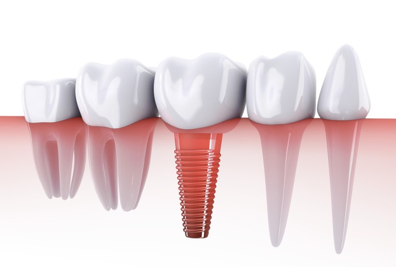 Your Precious Teeth, Implants at Seokplant! image 3