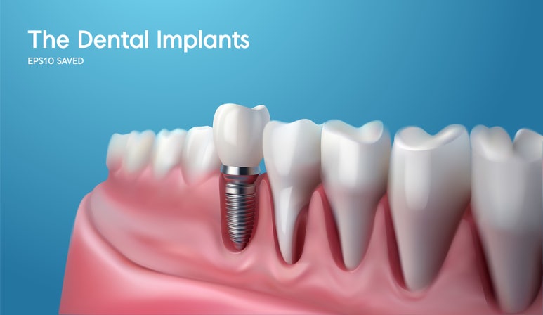 Implants: A Systematic Treatment Plan Is Half the Success image 2