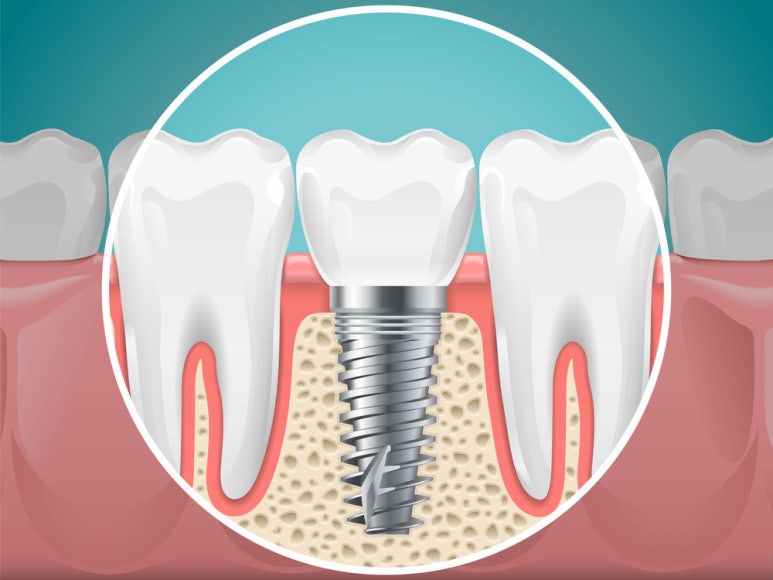 Why Should You Get Dental Implants image 7