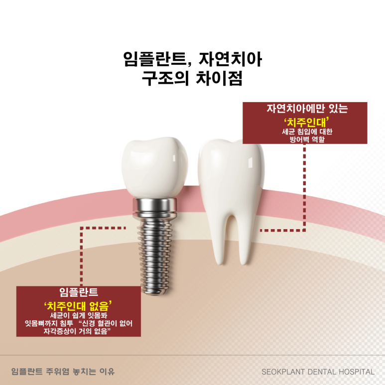 강남 석플란트 치과병원 임플란트 주위염 예방하려면? 관련 이미지 3