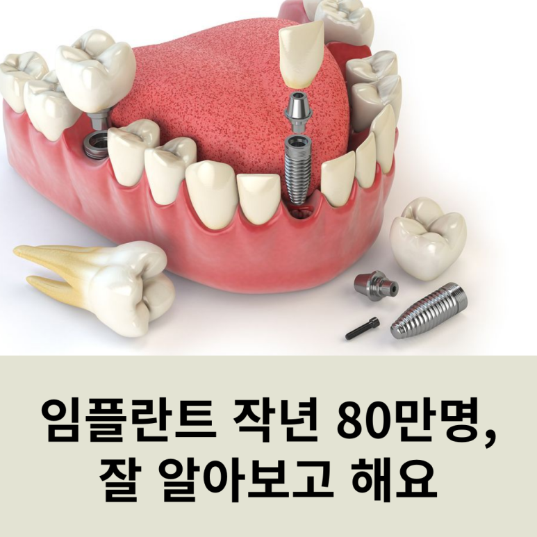 임플란트 작년 80만명, 잘 알아보고 해요 관련 이미지 8
