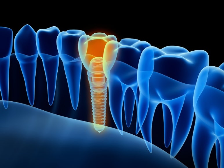 Learn About Implant Surgery at Seokplant Dental Hospital image 5
