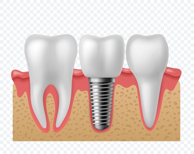 Why Is a Molar Implant Needed? Seokplant Dental Hospital image 1