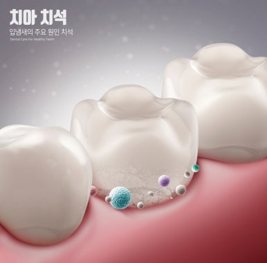 If You Want Implants to Last a Long Time, You Need to Change Your Habits image 4