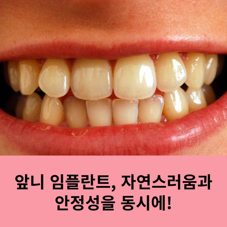 Front Tooth Implants: Achieving Natural Looks and Stability at the Same Time! image 9