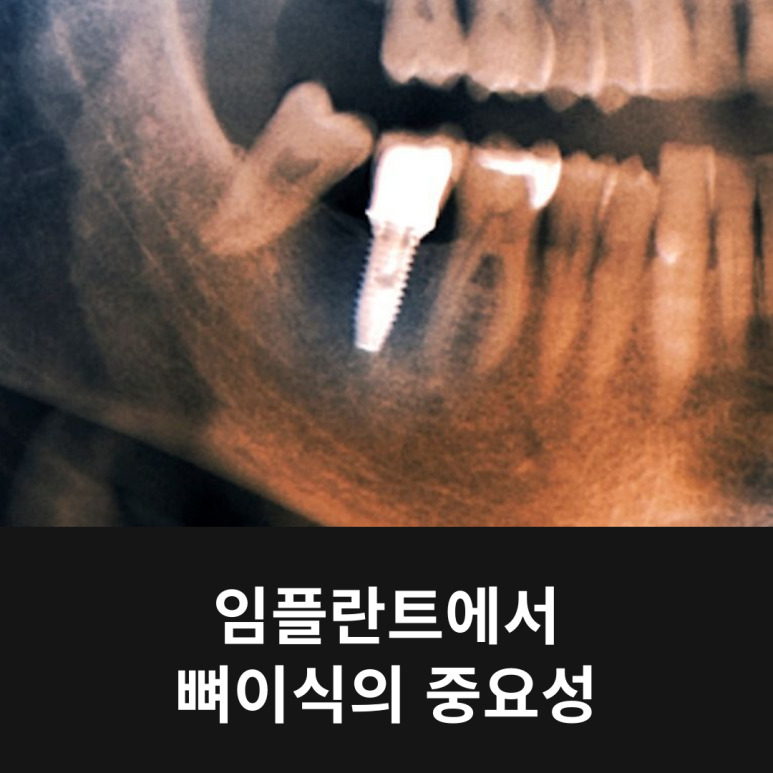 임플란트에서 뼈이식의 중요성 관련 이미지 9