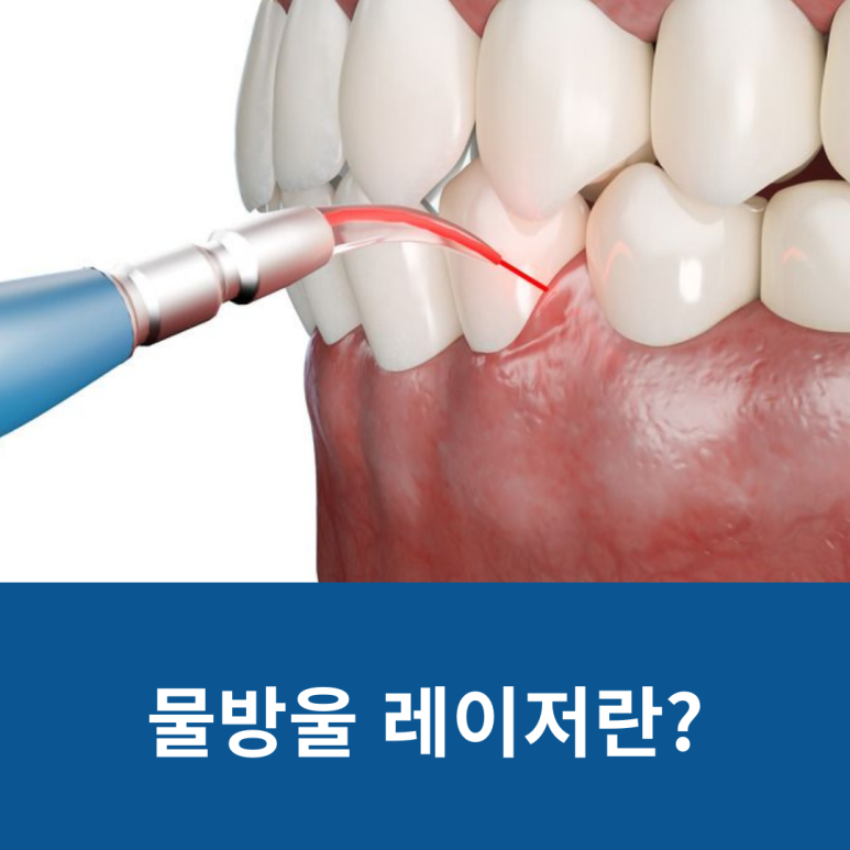 물방울 레이저란? 관련 이미지 5