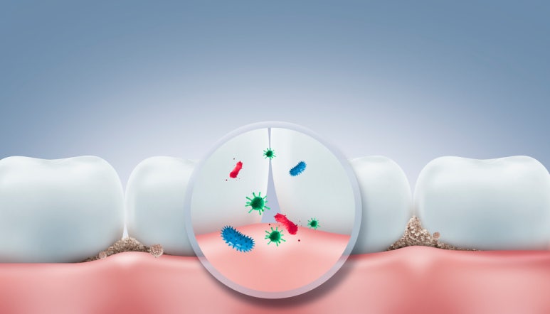 Prevention and Management of Periodontal Disease for Healthy Gums image 2