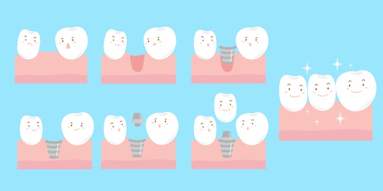 This Is What Happens If Tooth Loss Is Left Untreated image 1