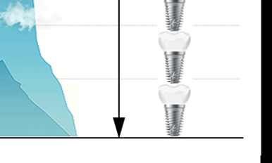 Dental Implant Bone Grafting: What Should You Be Careful About? image 25