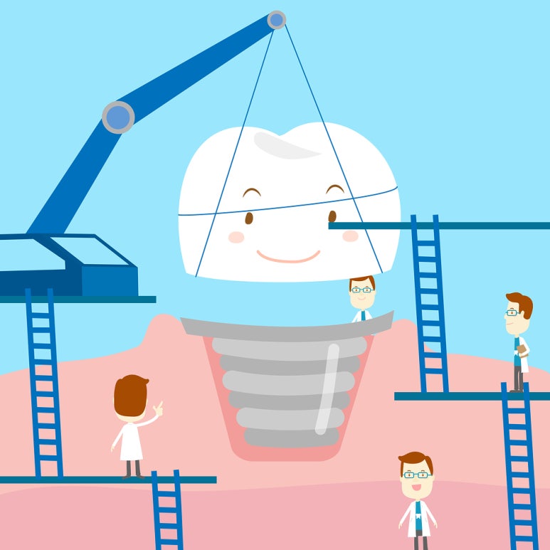 Smile with Confidence! Learn About the Dental Implant Process image 5