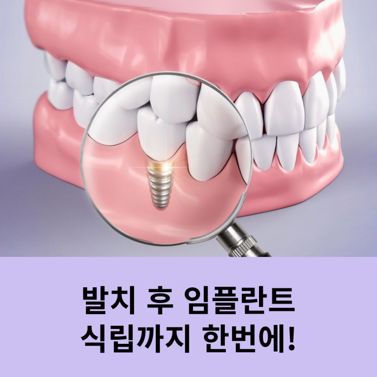 Immediate Implant Placement Right After Extraction! image 7
