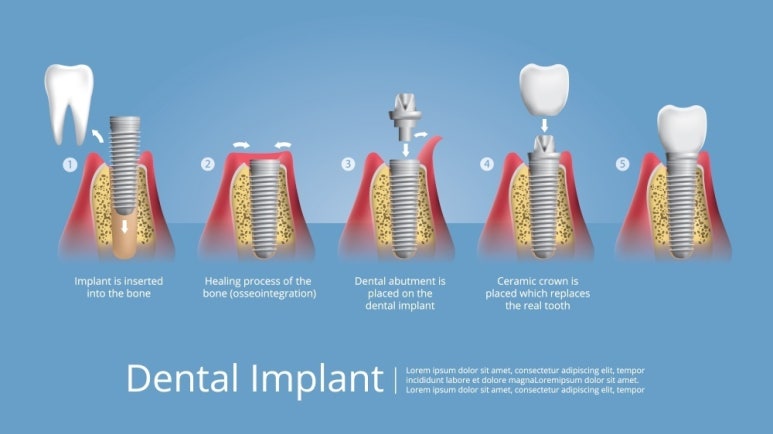 Dental Implant Bone Grafting: What Should You Be Careful About? image 3
