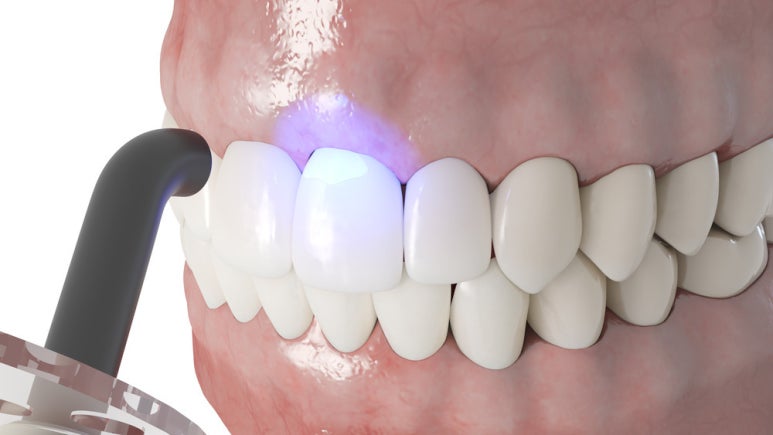 Prosthetic Treatment: What Are You Curious About? Part 2 image 2