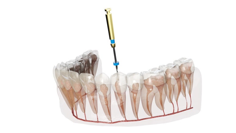 Prosthetic Treatment: What Are You Curious About? Part 2 image 1