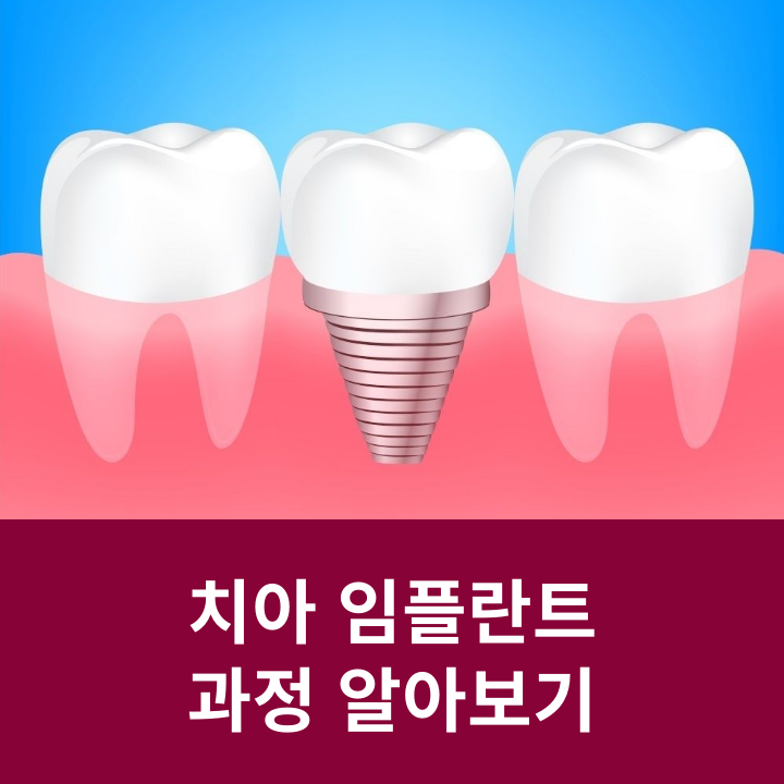 Smile with Confidence! Learn About the Dental Implant Process image 7