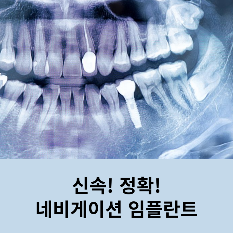 신속! 정확! 네비게이션 임플란트 관련 이미지 7