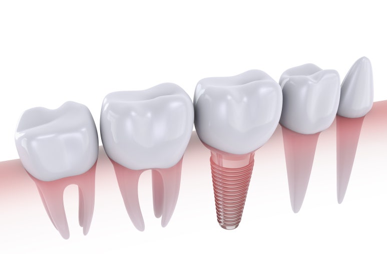 Seokplant Information on the Need for Implant Bone Graft Prices and Related Matters image 7