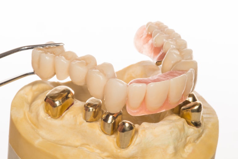 What Prosthetic Treatment Is Good for Me? image 3
